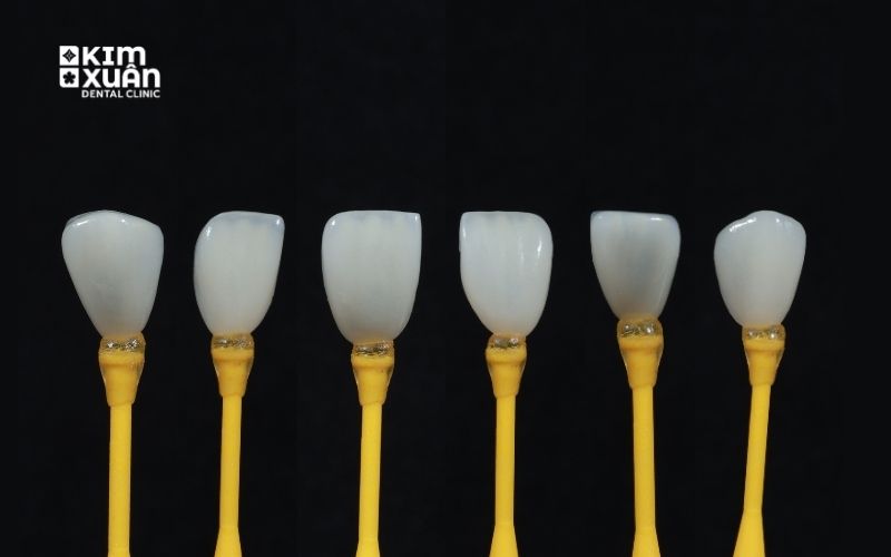 Dán Răng Sứ Veneer Ưu Nhược Điểm