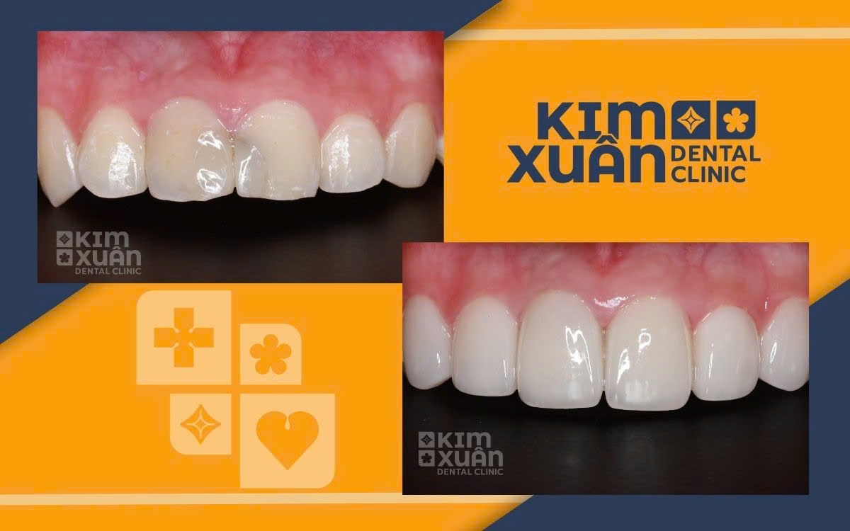 Dán Sứ Emax Tại Nha Khoa Kim Xuân