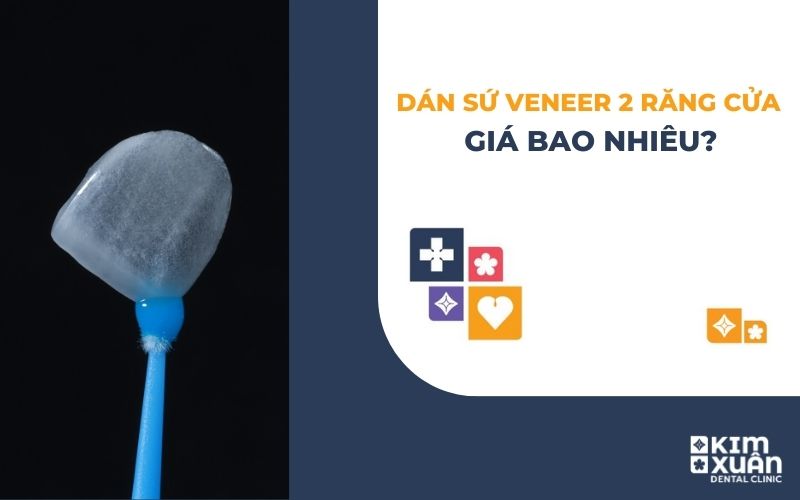 Dán Sứ Veneer 2 Răng Cửa Giá Bao Nhiêu
