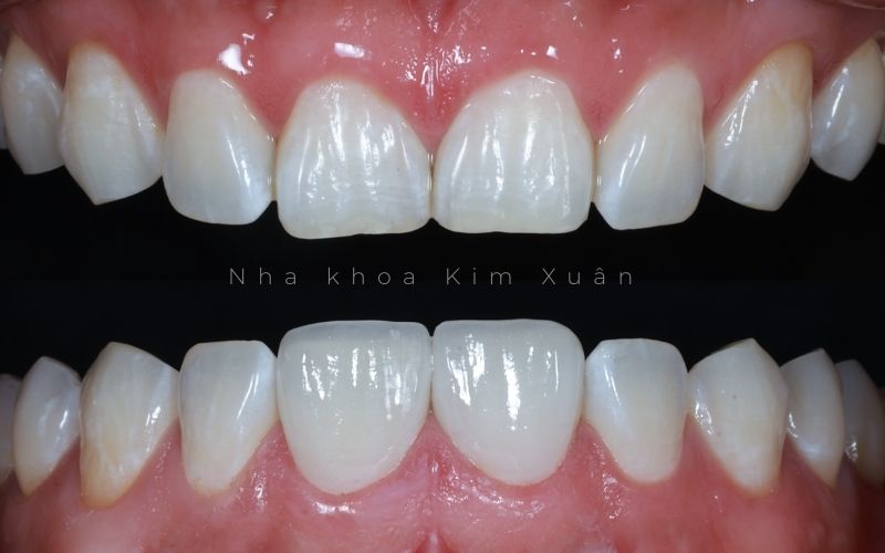 Dán Sứ Veneer 2 Răng Cửa Bị Thưa Bao Nhiêu Tiền