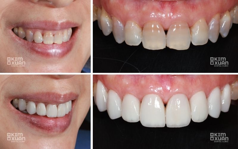 Hình ảnh trước và sau dán sứ Veneer cải thiện răng cửa thưa và màu răng thiếu hài hòa