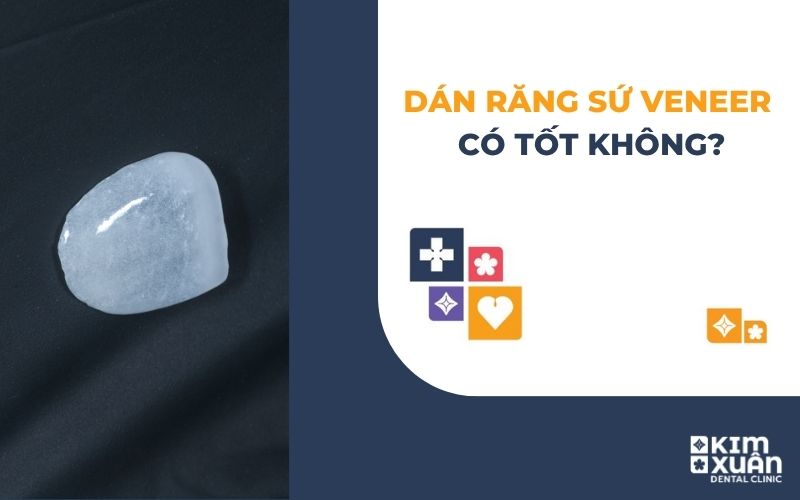 Dán Sứ Veneer Có Tốt Không