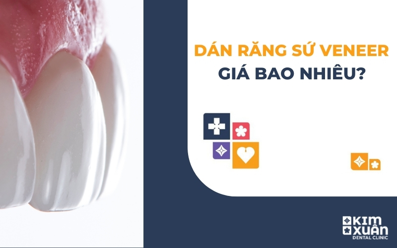 Dán Sứ Veneer Giá Bao Nhiêu