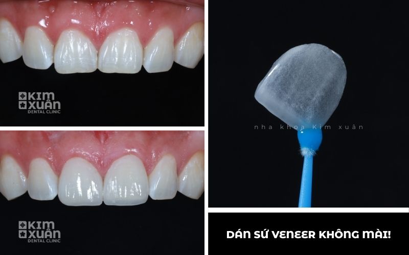 Ảnh Dán Sứ Veneer Không Mài