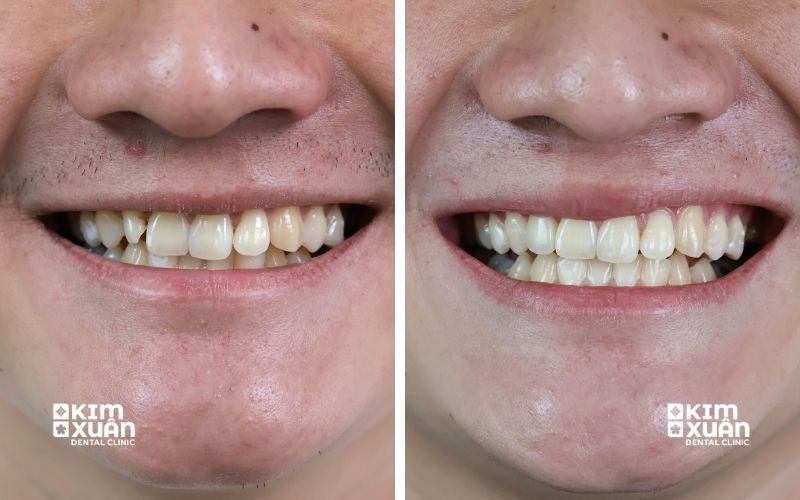 Dán Sứ Veneer Không Mài Tại Nha Khoa Kim Xuân