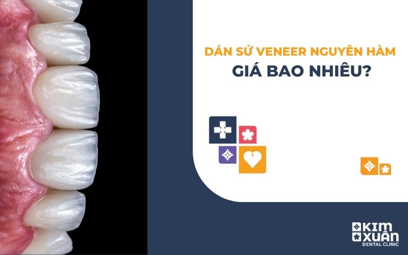 Dán Sứ Veneer Nguyên Hàm Giá Bao Nhiêu