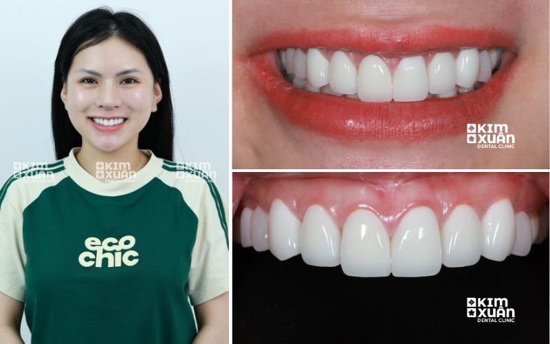 Dán Sứ Veneer Tại Nha Khoa Kim Xuân 