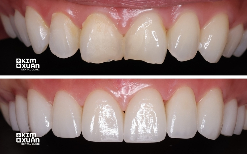 Dán Sứ Veneer Nha Khoa Kim Xuân