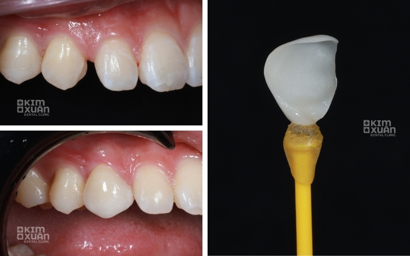 Dán Sứ Veneer Răng Thưa