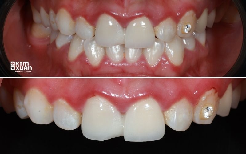 Dấu Hiệu Bọc Răng Sứ Bị Viêm Lợi