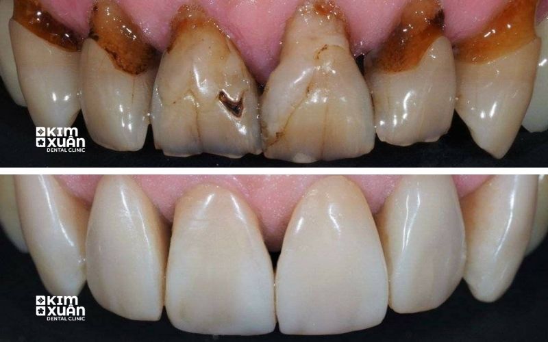Dấu Hiệu Nhận Biết Bọc Răng Sứ Bị Viêm Lợi