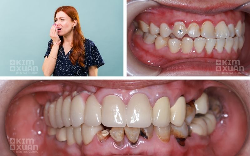 Dấu Hiệu Nhận Biết Chân Răng Bị Đen