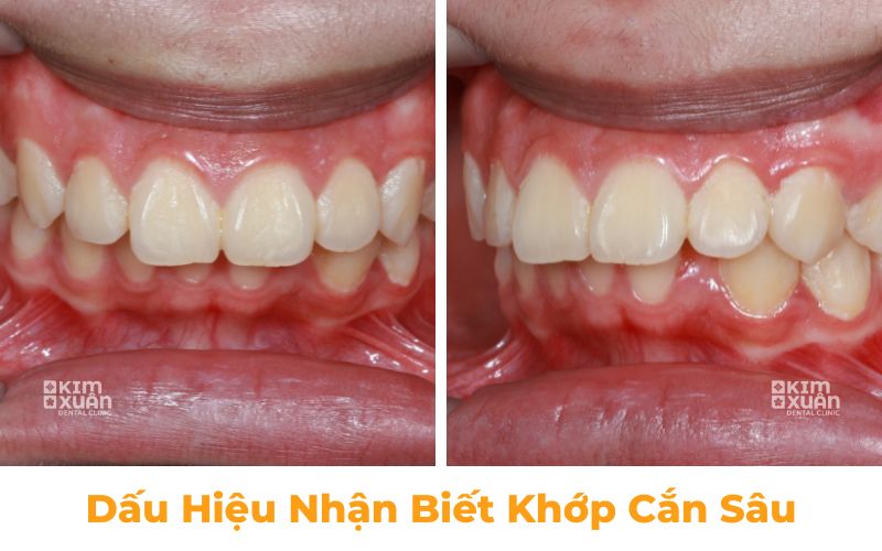 Dấu hiệu nhận biết khớp căn sâu