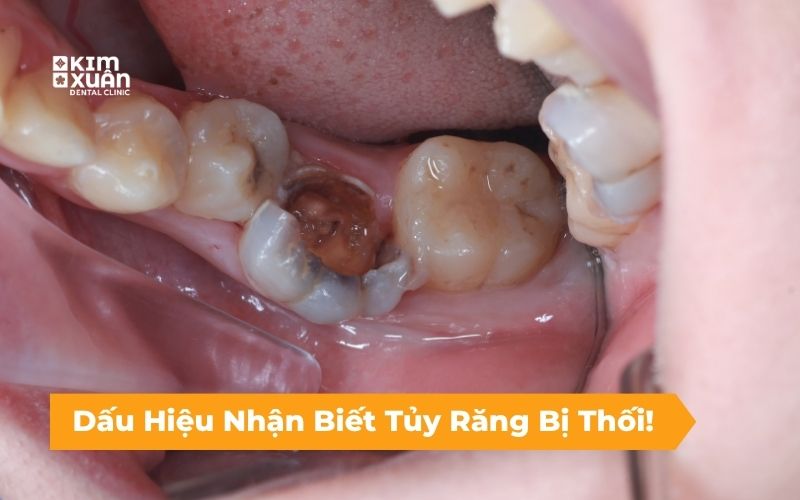 Dấu Hiệu Nhận Biết Răng Bị Thối Tủy