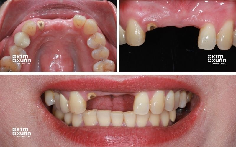 Dấu Hiệu Nhận Biết Răng Hàm Bị Sâu