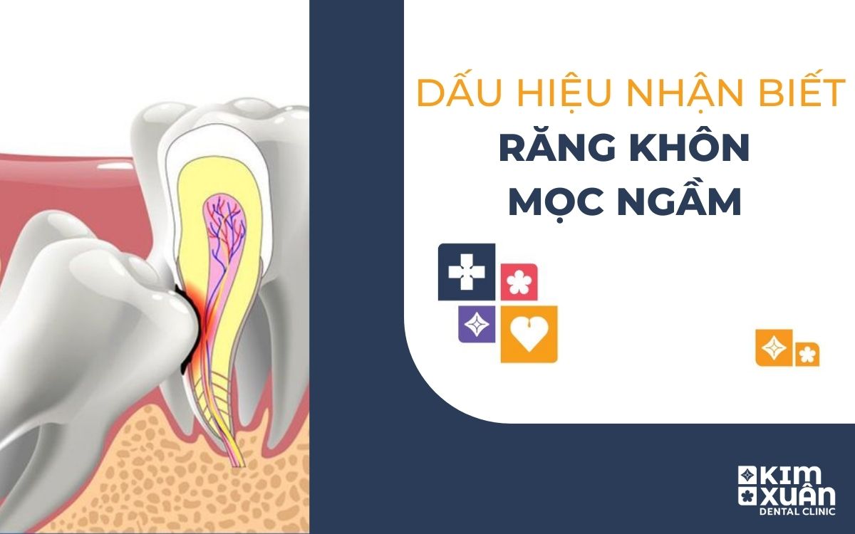 Dấu Hiệu Nhận Biết Răng Khôn Mọc Ngầm