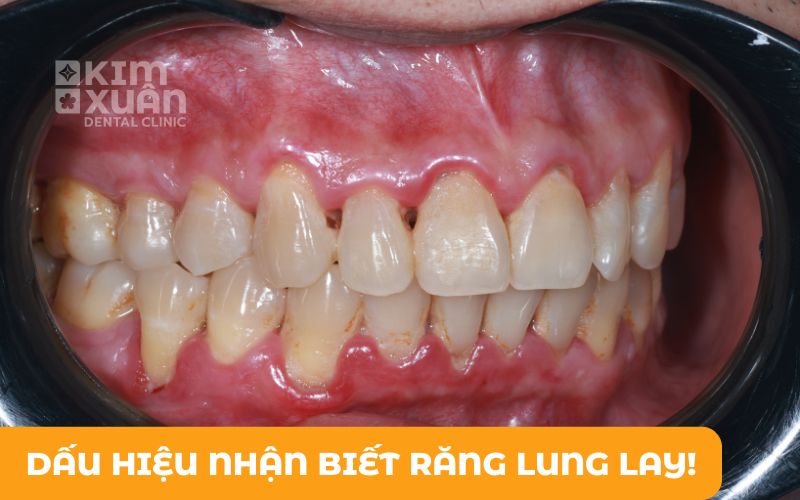 Dấu Hiệu Nhận Biết Răng Lung Lay