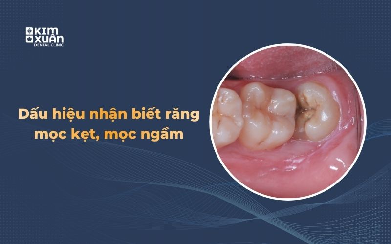 Dấu hiệu nhận biết răng mọc kẹt