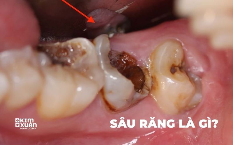Dấu Hiệu Nhận Biết Răng Sâu