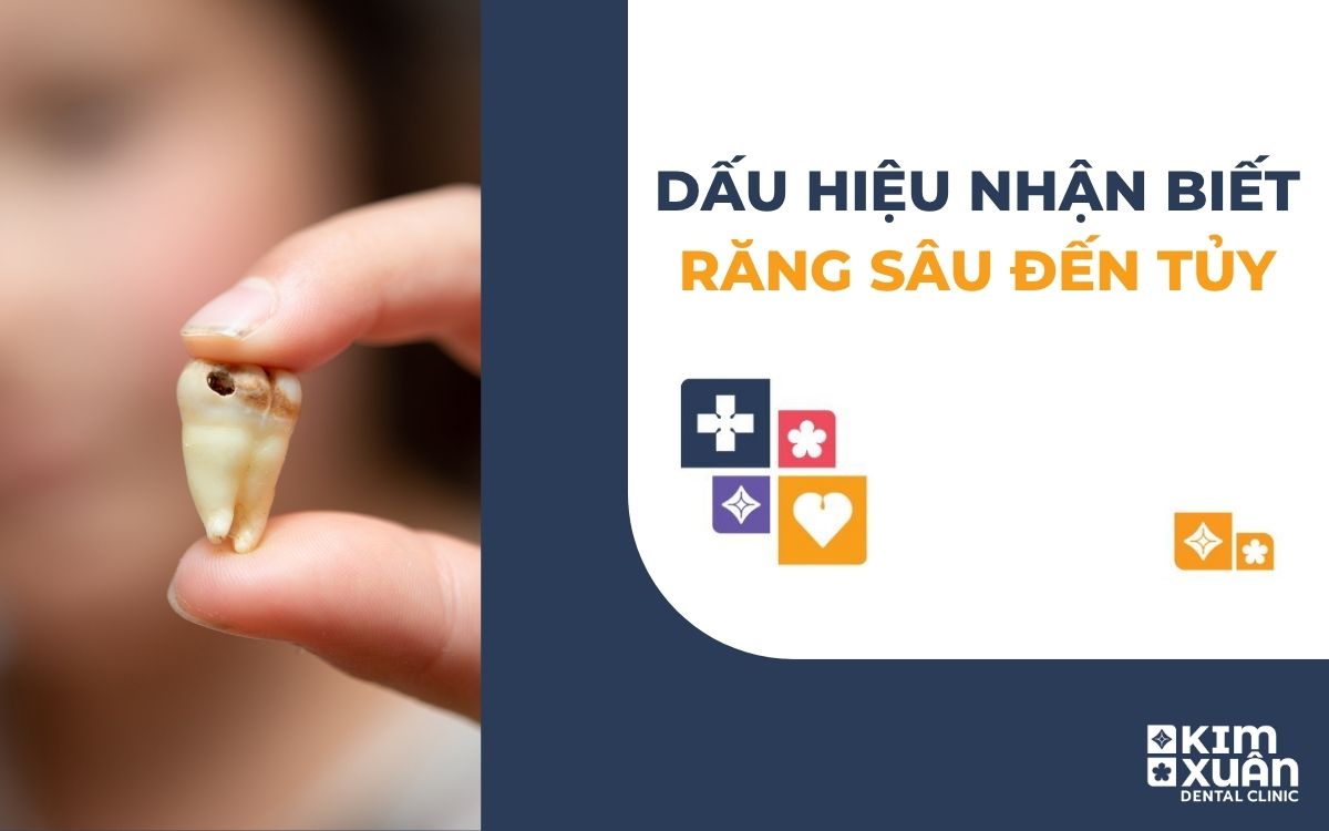 Dấu Hiệu Nhận Biết Răng Sâu Đến Tủy