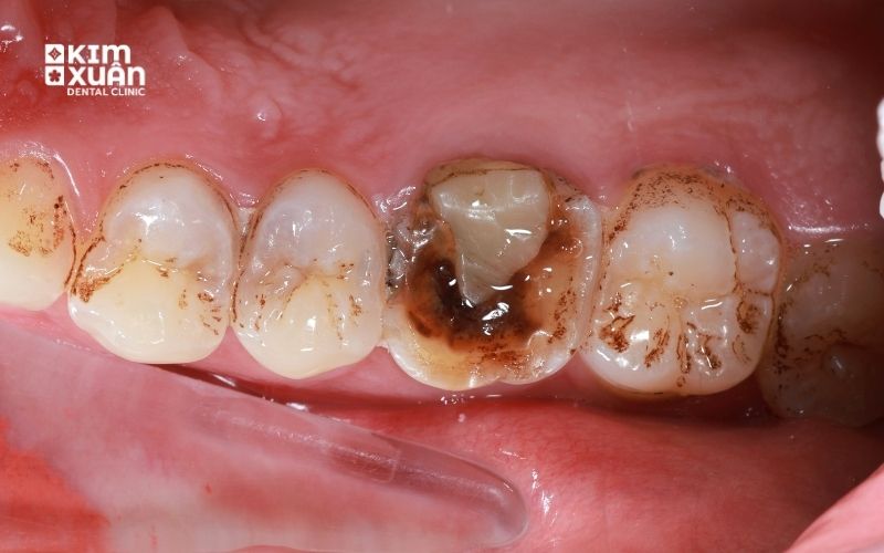 Dấu Hiệu Nhận Biết Răng Sâu Lỗ To