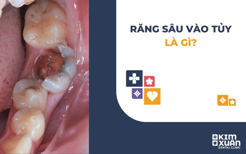 Dấu Hiệu Nhận Biết Răng Sâu Vào Tủy