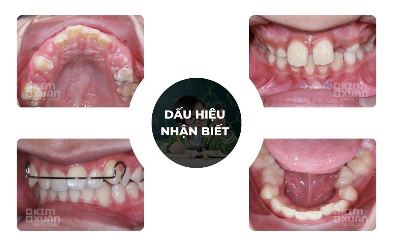Dấu Hiệu Nhận Biết Răng Vĩnh Viễn Mọc Lệch