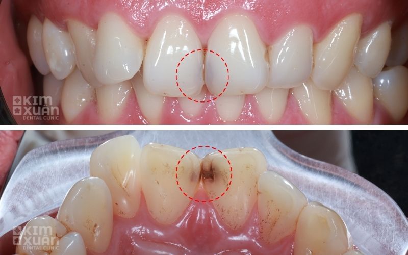 Dấu Hiệu Nhận Biết Răng Cửa Bị Sâu