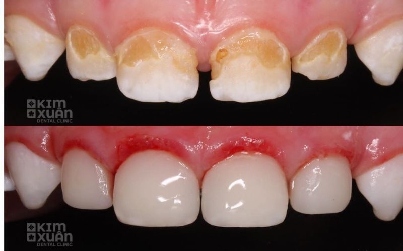Dấu Hiệu Nhận Biết Sâu Răng Sữa Ở Trẻ Em