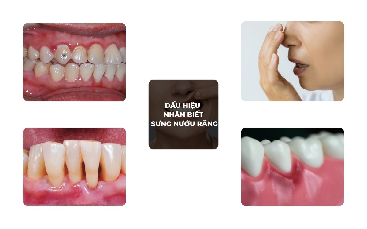 Dấu Hiệu Nhận Biết Sưng Nướu Răng