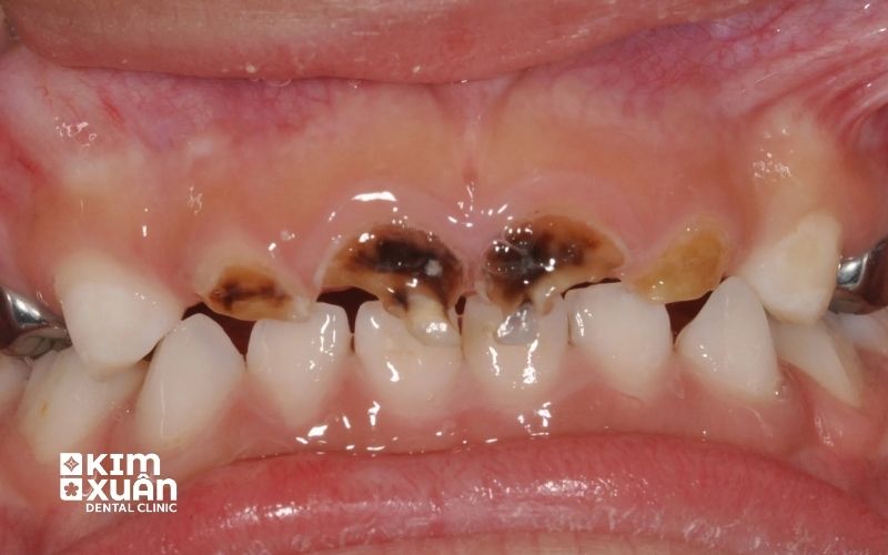 Dấu Hiệu Nhận Biết Trẻ Bị Sún Răng