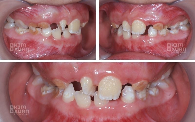 Dấu Hiệu Nhận Biết Viêm Lợi Ở Trẻ Em