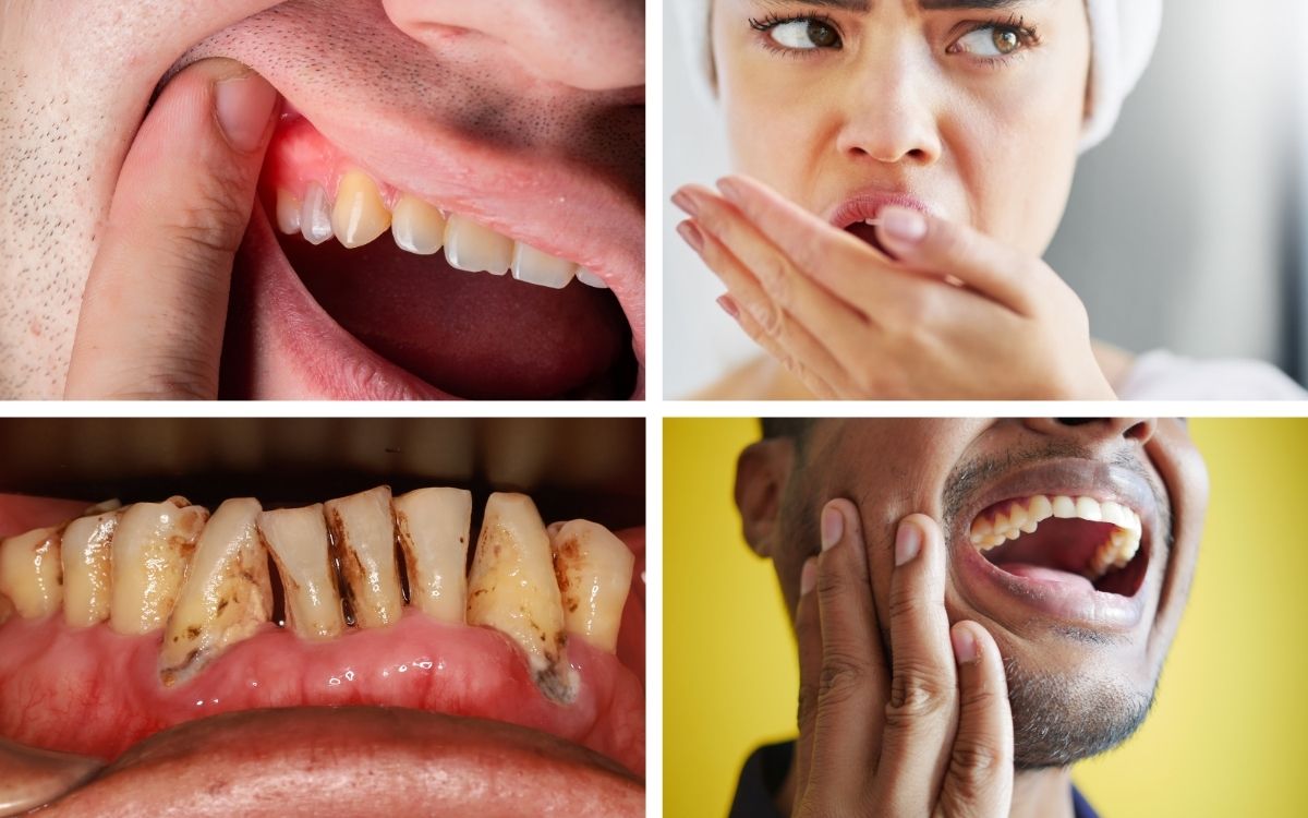 Dấu Hiệu Nhận Biết Viêm Nha Chu