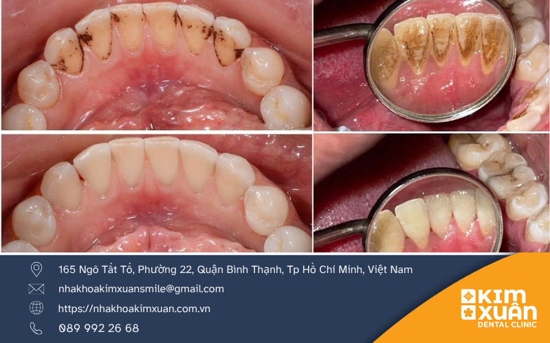 Dấu Hiệu Nhận Biết Viêm Nha Chu