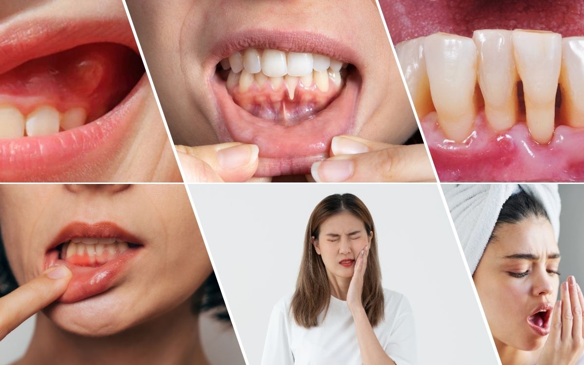 Dấu Hiệu Nhận Biết Viêm Nướu