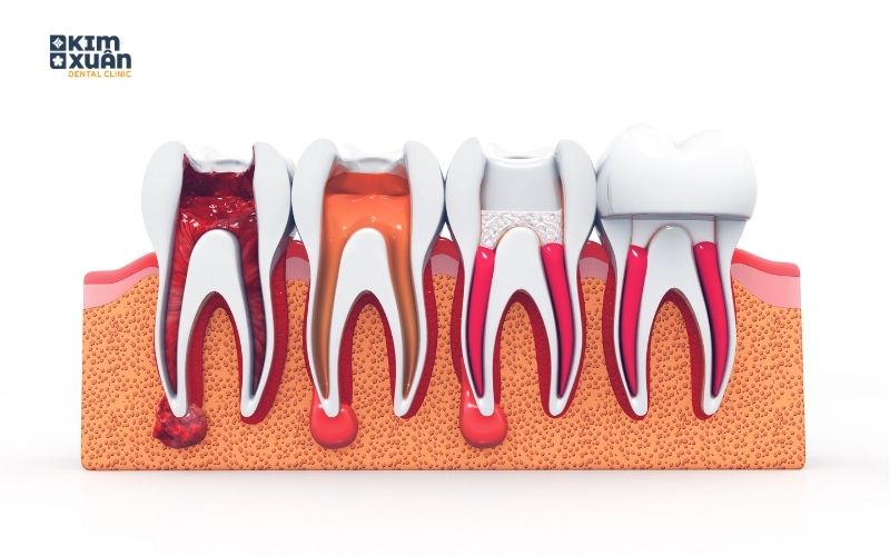 Dấu Hiệu Nhận Biết Viêm Tủy Răng