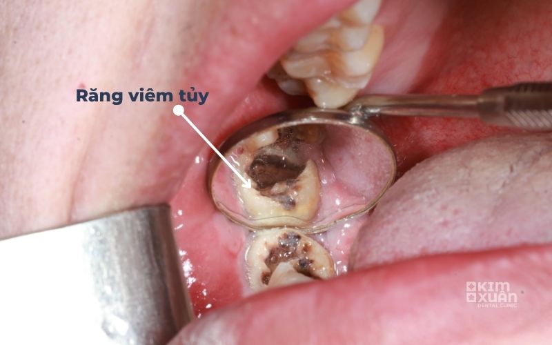 Dấu Hiệu Nhận Biết Viêm Tủy Răng