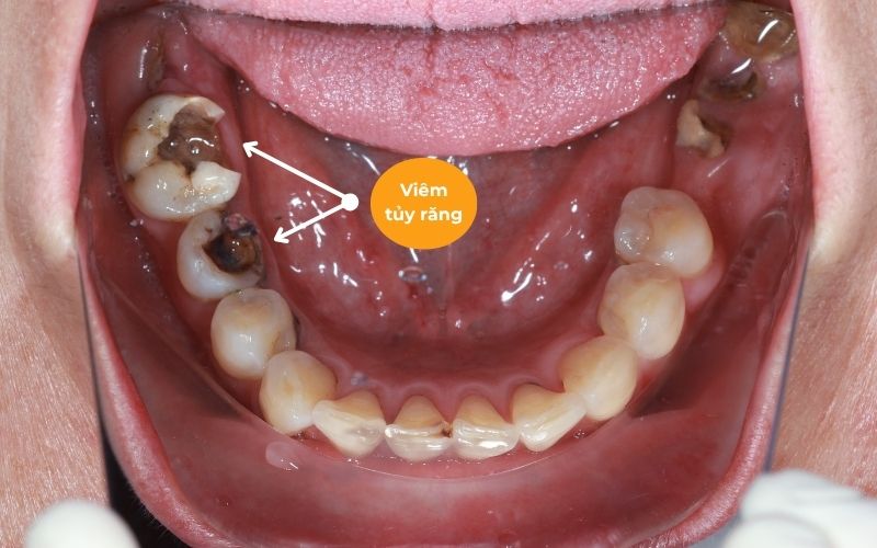 Dấu hiệu nhận biết viêm tủy răng