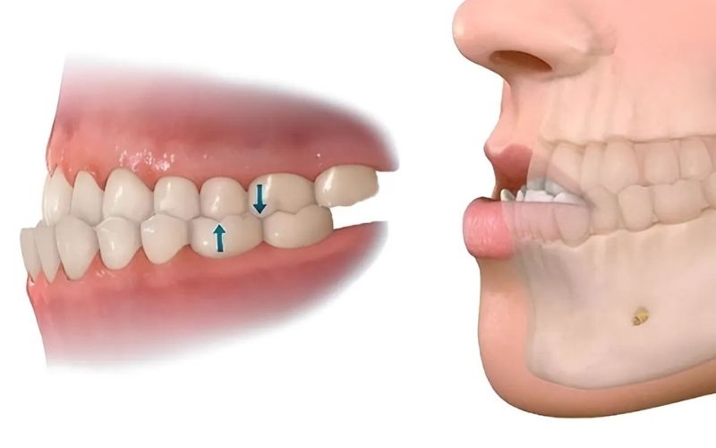Dấu Hiệu Nhân Biết Răng Bị Móm