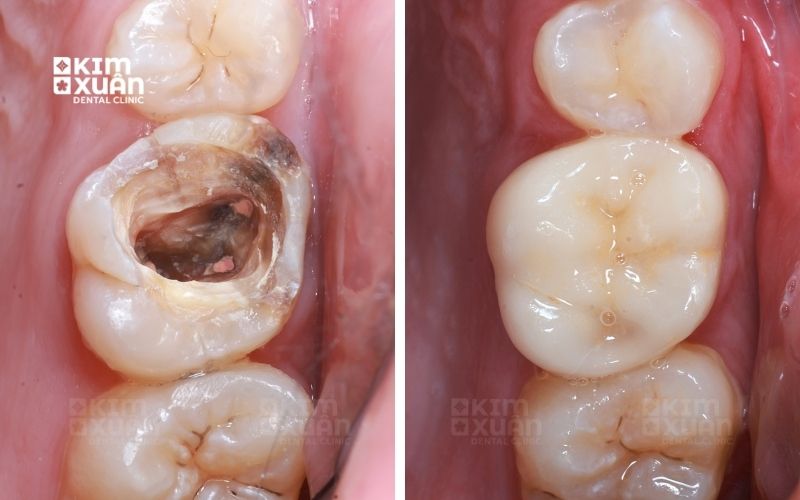 Dấu Hiệu Răng Chết Tủy