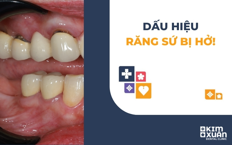 Dấu Hiệu Răng Sứ Bị Hở