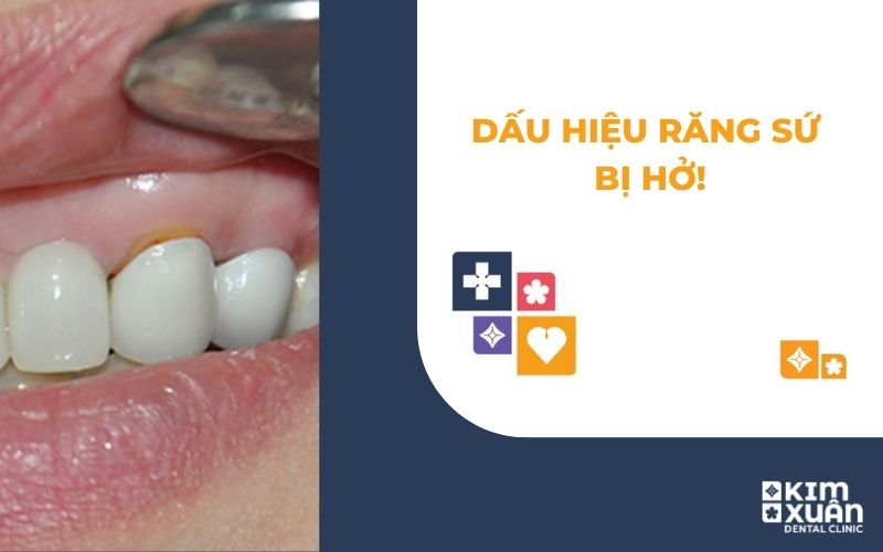 Dấu Hiệu Răng Sứ Bị Hở