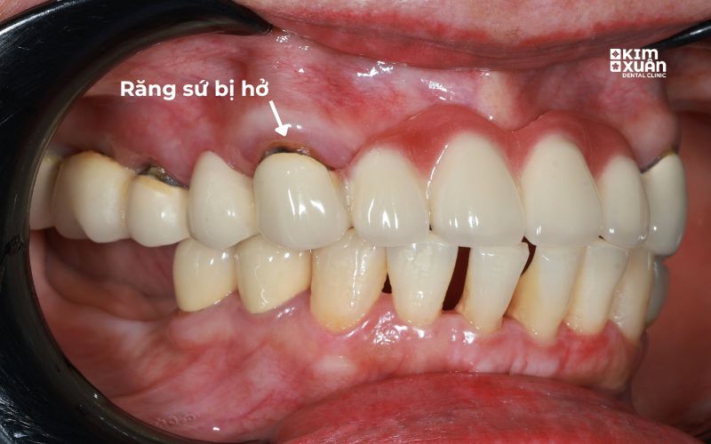 Dấu Hiệu Răng Sứ Cần Phải Thay