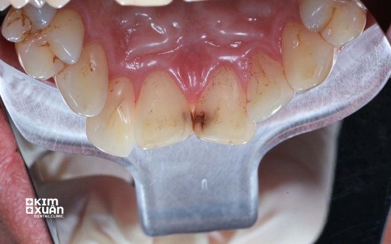 Dấu Hiệu Sâu Răng Cửa