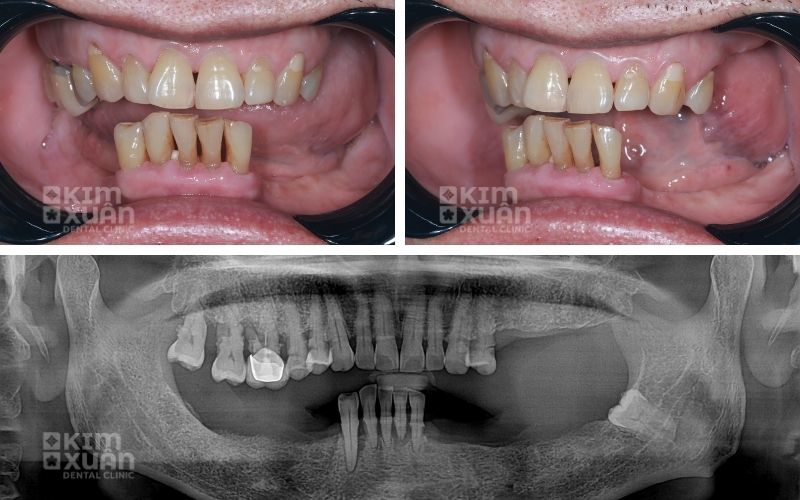 Dấu Hiệu Tiêu Xương Hàm