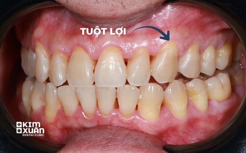Dấu Hiệu Tụt Lợi Chân Răng
