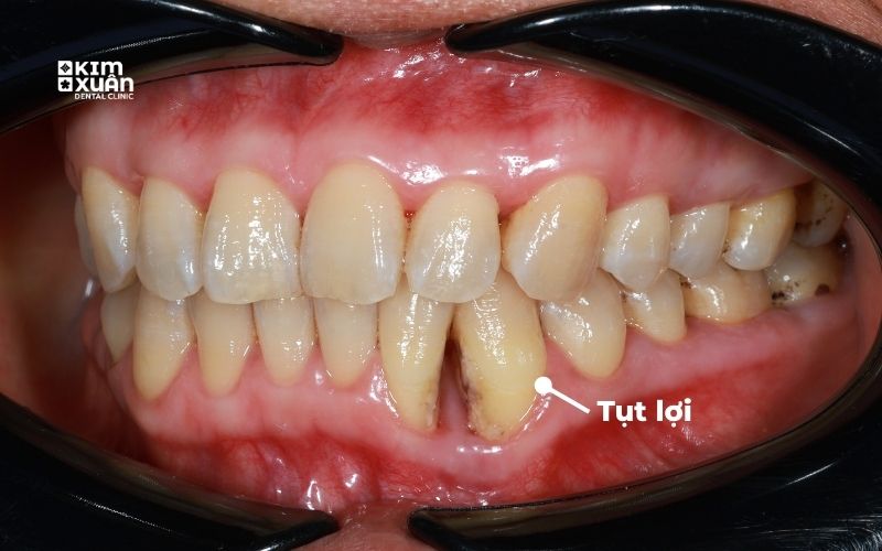 Dấu Hiệu Tụt Lợi Chân Răng