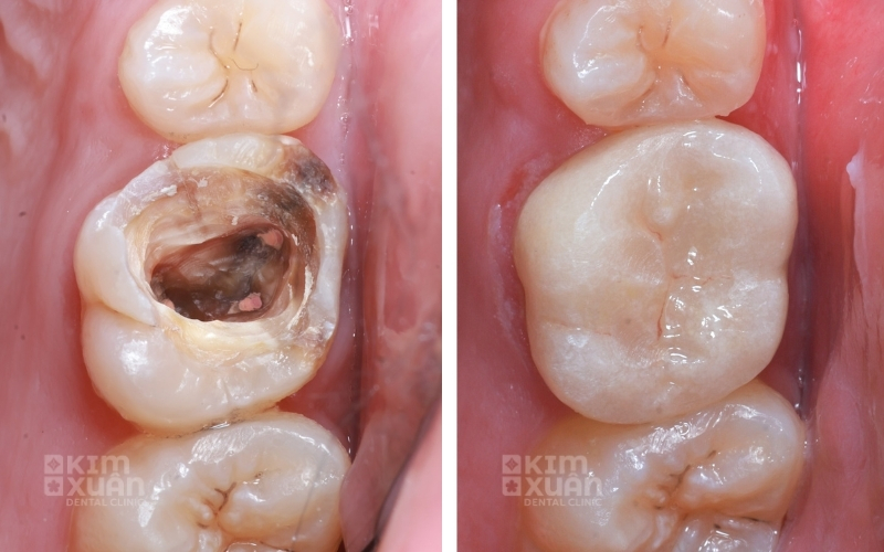 Dấu Hiệu Viêm Tủy Răng