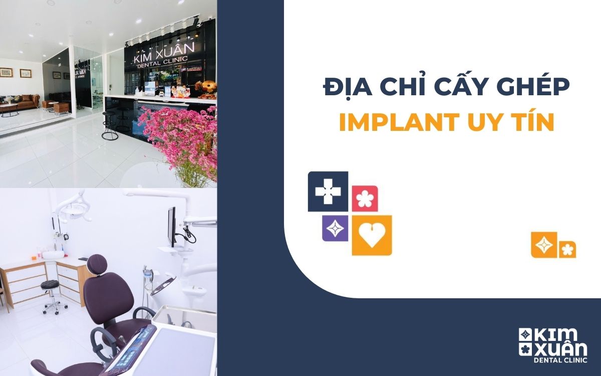 Địa Chỉ Cấy Ghép Implant Uy Tín Hồ Chí Minh