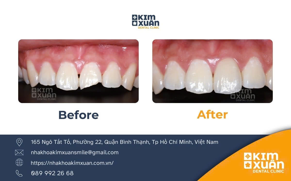 Địa Chỉ Dán Răng Sứ Veneer Uy Tín